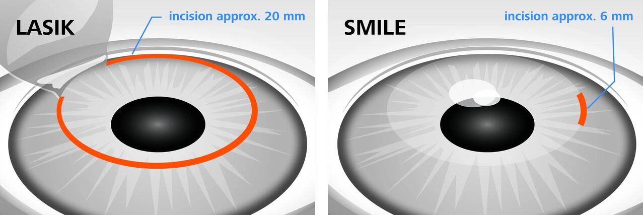 Comparison of LASIK and SMILE laser vision correction methods